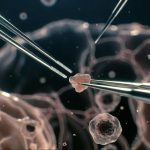 Microscopic Brain Tumor Surgery1