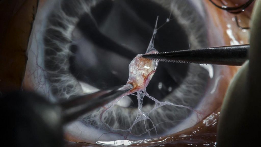 Microscopic PLID Surgery