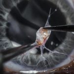 Microscopic PLID Surgery