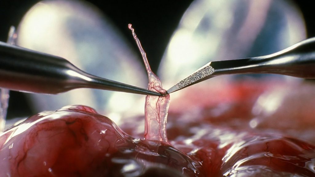 Microscopic PLID Surgery